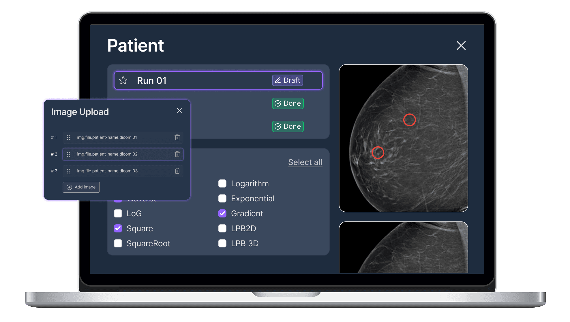 MammoRadiomics patient analysis interface on MacBook